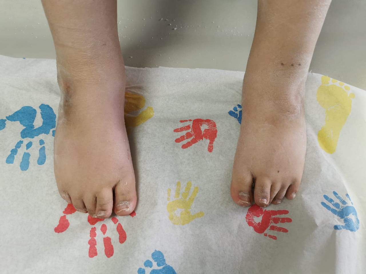 Pie Equino Varo Aducto Congénito ¿Qué es? ¿En qué consiste?