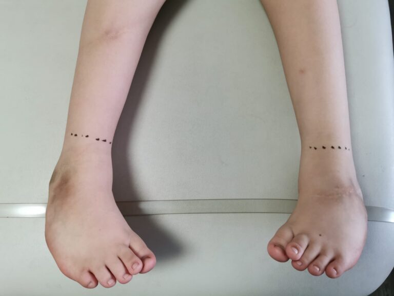 Pie Equino Varo Aducto Congénito ¿Qué es? ¿En qué consiste?