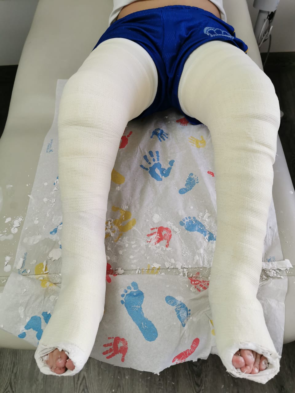 Pie Equino Varo Aducto Congénito ¿Qué es? ¿En qué consiste?